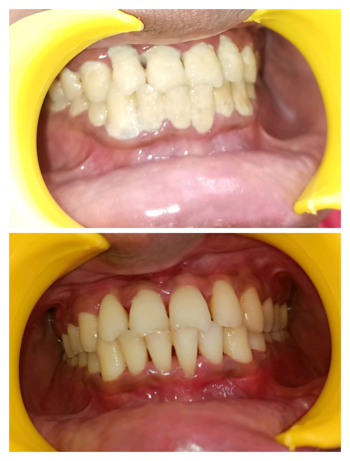 Teeth Cleaning Before and After - Saakriti Dental Care